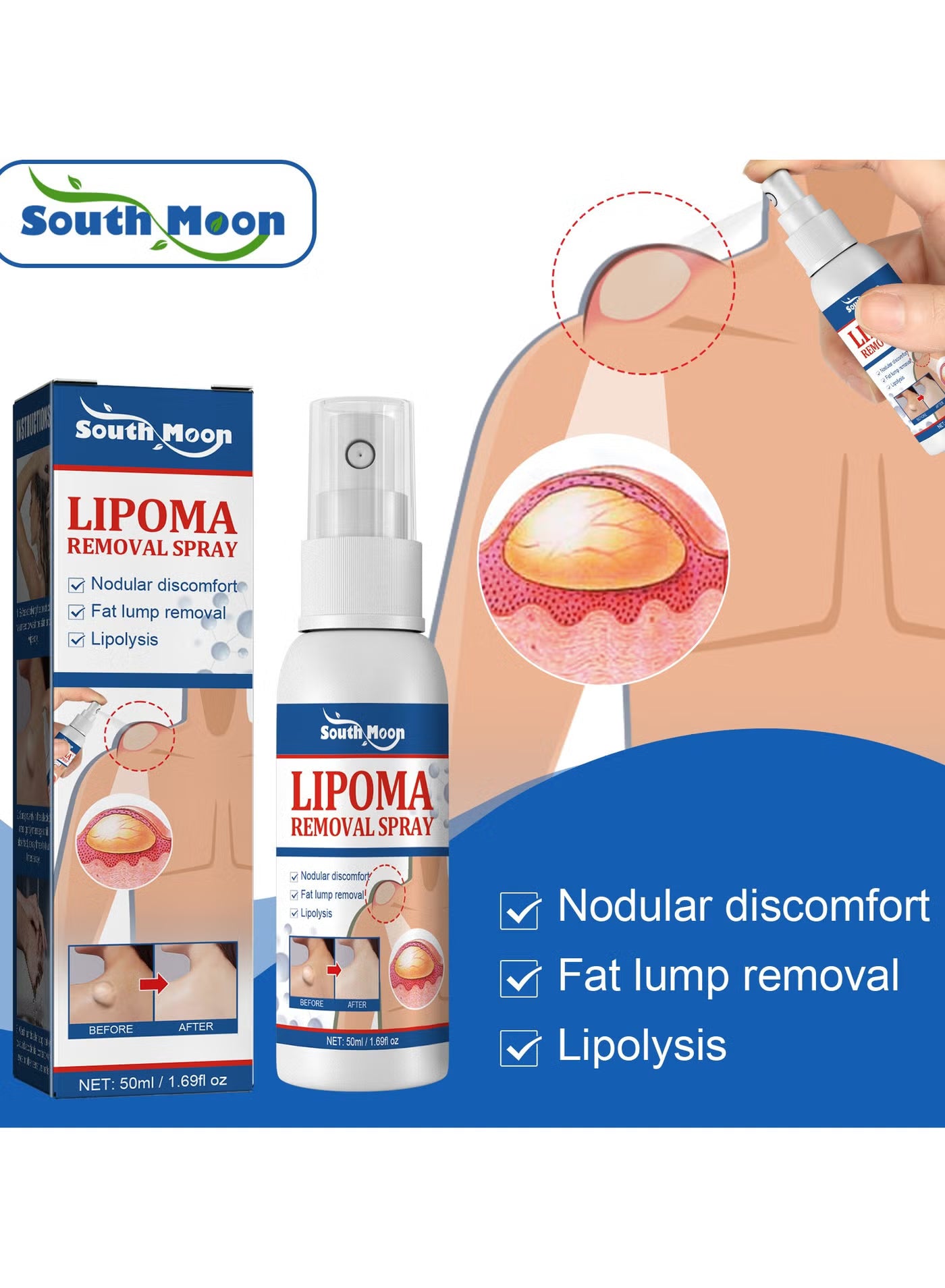 South Moon Lipoma Removal Cream