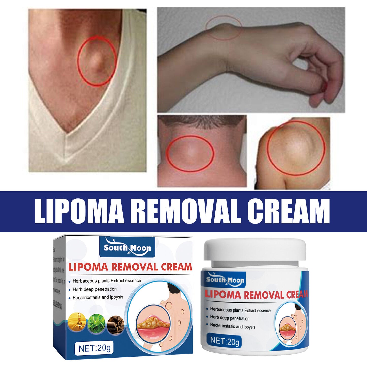 South Moon Lipoma Removal Cream