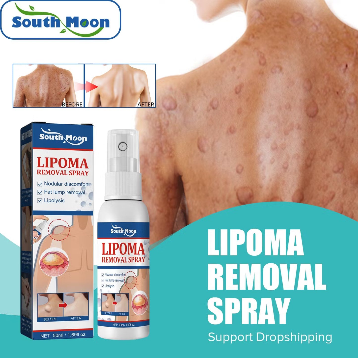 South Moon Lipoma Removal Cream