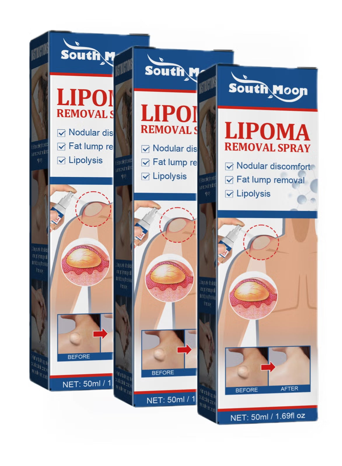 South Moon Lipoma Removal Cream
